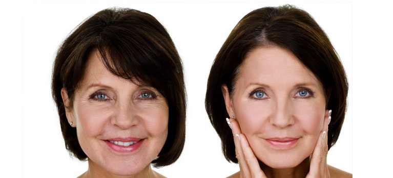 How Micro Needling Can Help You Look 10 Years Younger