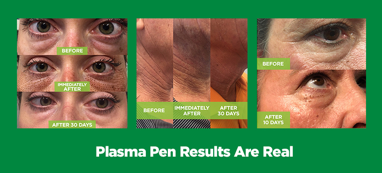 PLASMA PEN: A UNIQUE TREATMENT FOR MORE YOUTHFUL SKIN