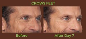 Men botox, crows feet